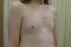 Transgender breast augmentation